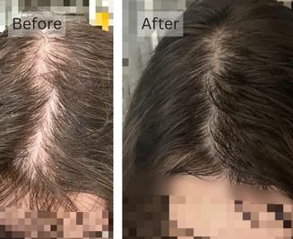 Hair Loss & Thinning