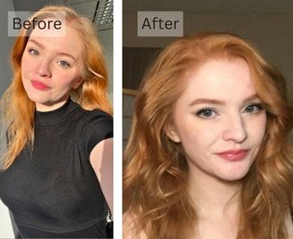 Hair Loss & Thinning