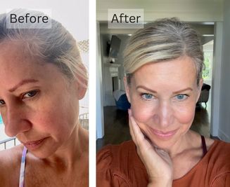 Loss of Skin Elasticity