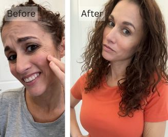 Loss of Skin Elasticity