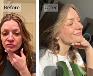 Loss of Skin Elasticity