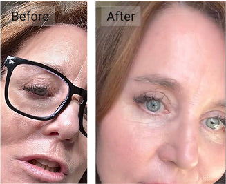 Loss of Skin Elasticity
