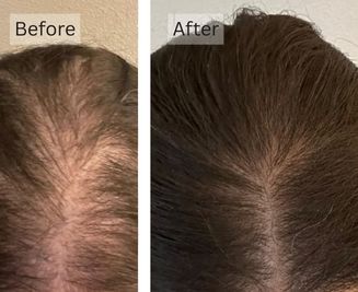 Scalp Sensitivity, and Irritation