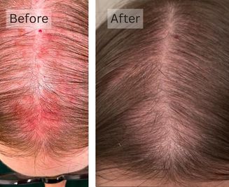 Scalp Sensitivity, and Irritation
