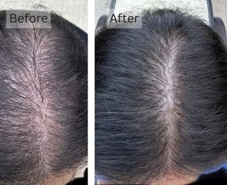 Scalp Sensitivity, and Irritation